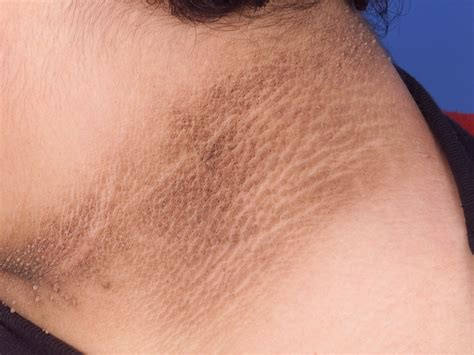 CaryKelly11's tweet photo. These are clinical markers of hyperinsulinemia (high insulin levels in the blood) on the skin in obese, non-diabetics. They are indicators of poor metabolic health and can all be banished by a proper human diet. #AcanthosisNigricans #SkinTags #KeratosisPilaris #PlantarHyperkeratosis https://t.co/sDSCNO62UR