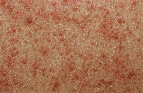 CaryKelly11's tweet photo. These are clinical markers of hyperinsulinemia (high insulin levels in the blood) on the skin in obese, non-diabetics. They are indicators of poor metabolic health and can all be banished by a proper human diet. #AcanthosisNigricans #SkinTags #KeratosisPilaris #PlantarHyperkeratosis https://t.co/sDSCNO62UR