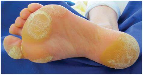 CaryKelly11's tweet photo. These are clinical markers of hyperinsulinemia (high insulin levels in the blood) on the skin in obese, non-diabetics. They are indicators of poor metabolic health and can all be banished by a proper human diet. #AcanthosisNigricans #SkinTags #KeratosisPilaris #PlantarHyperkeratosis https://t.co/sDSCNO62UR