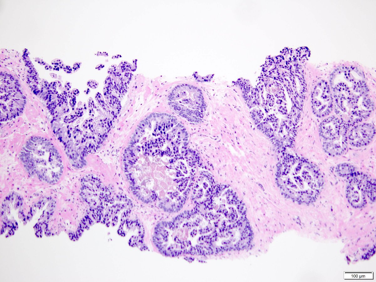 CuringN's tweet photo. Prostate gland & seminal vesicles - What's your diagnosis?
Topic link: https://t.co/XiD9jb4QVN
Images contributed by Alcino Pires Gama, M.D.
Visit our CCN blog for cancer-related essays by Dr. Pernick: https://t.co/aaLBk9BA8J.
#CancerResearch #CuringCancerNetwork #Pathology https://t.co/WlTpH4hlaz