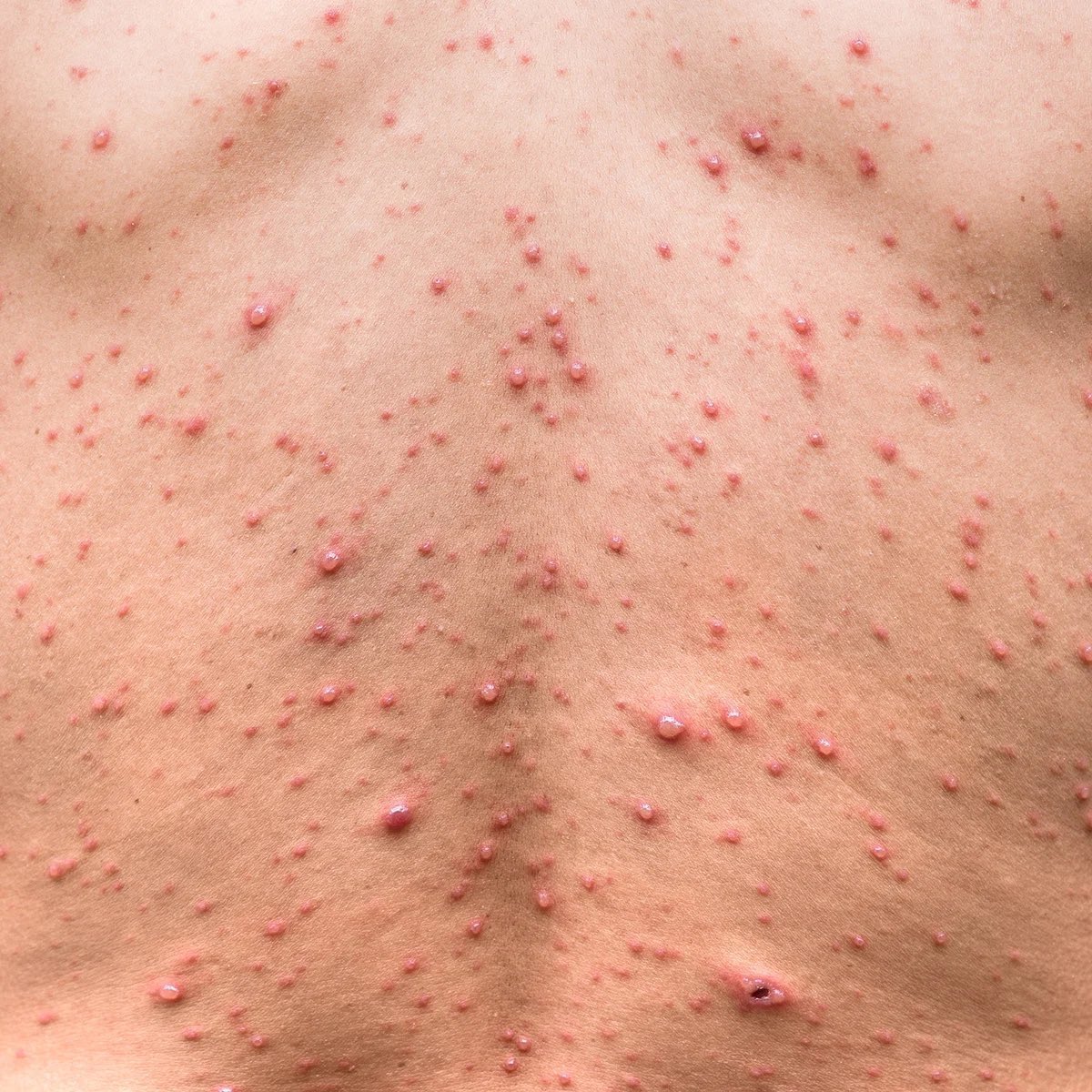 safonyameherbal's tweet photo. For your CHICKEN POX and MEASLES, grind guava leaves, add salt to it and apply on the affected part twice daily🍀…. It very effective in treating the chicken pox rash without leaving dark spots🤝

The solution is at your backyard https://t.co/MTK2cqyVza