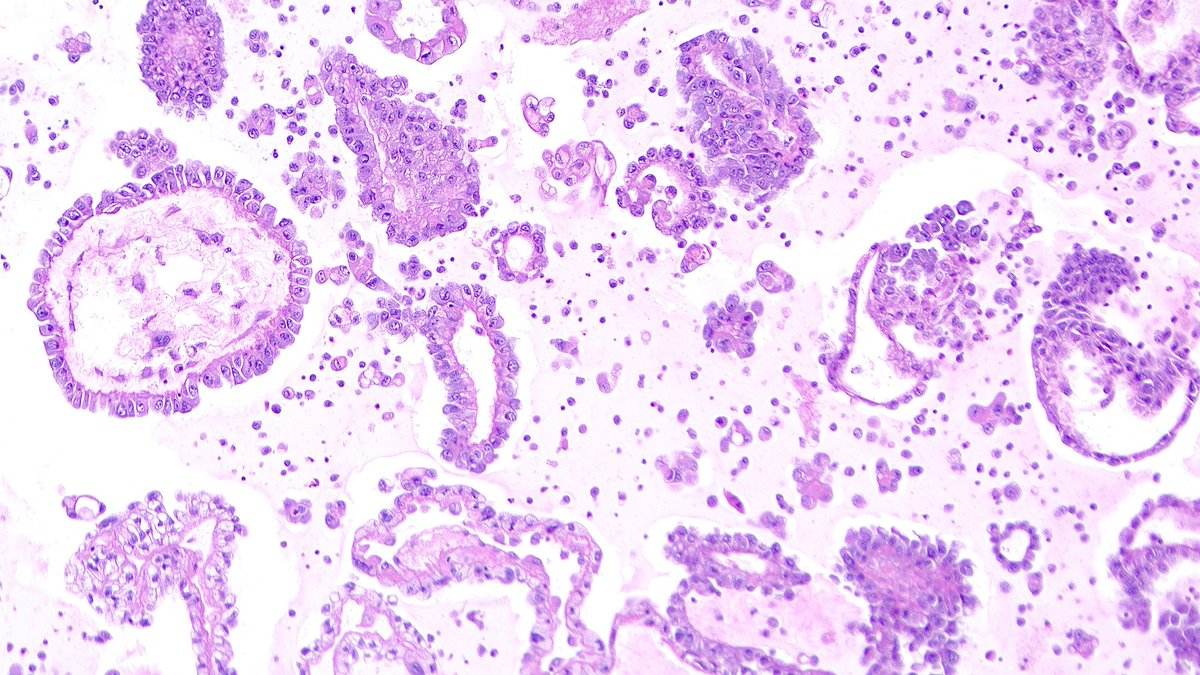 An impressive cell block preparation from a peritoneal fluid #CytoPath specimen in a patient with history of papillary renal cell carcinoma. What #IHC (s) would you order to confirm the diagnosis?