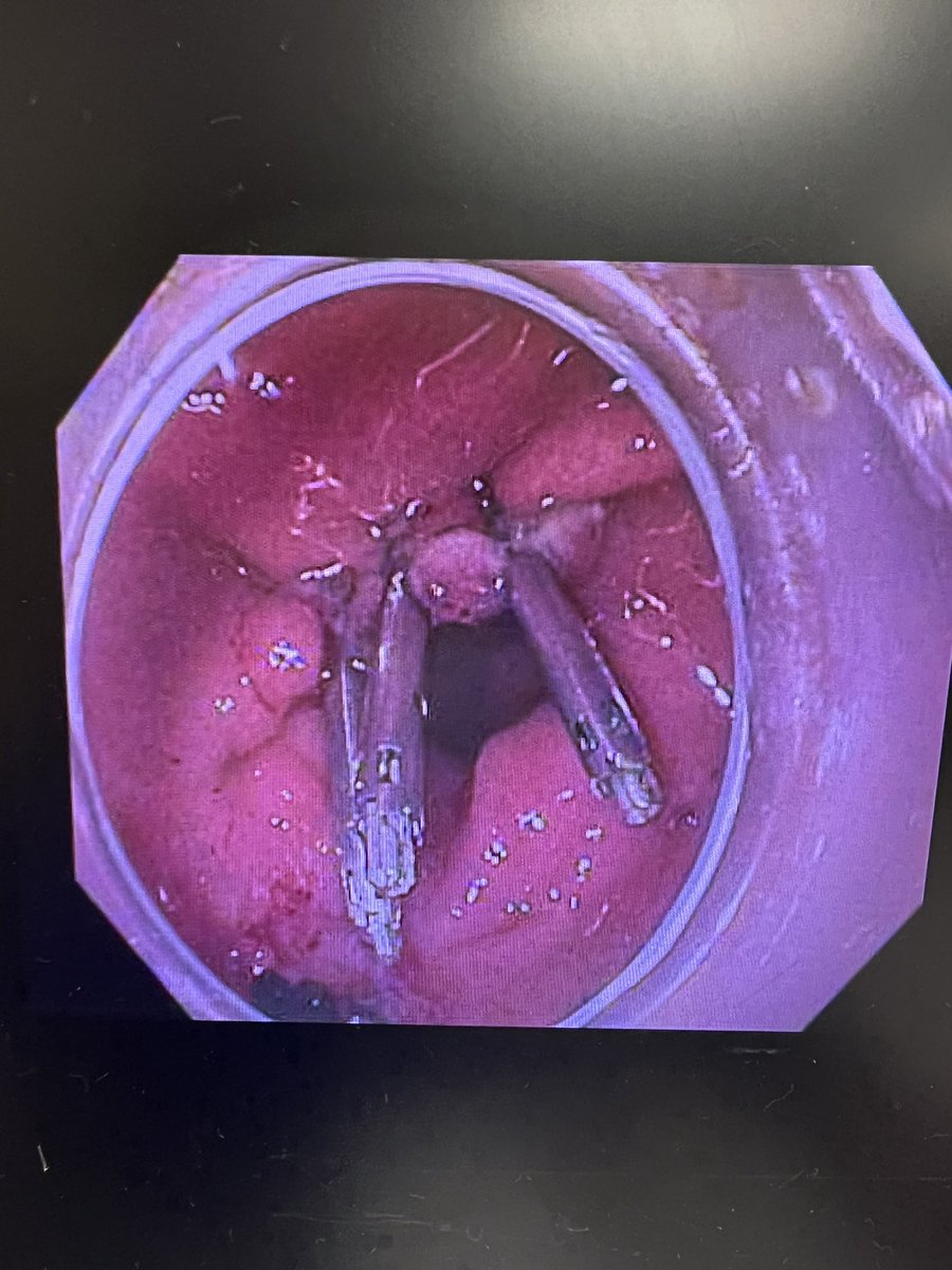 Something very satisfying when doing a G-POEM to help patients suffering from gastroparesis. Thoughts on lesser vs greater curve approach? 🤔