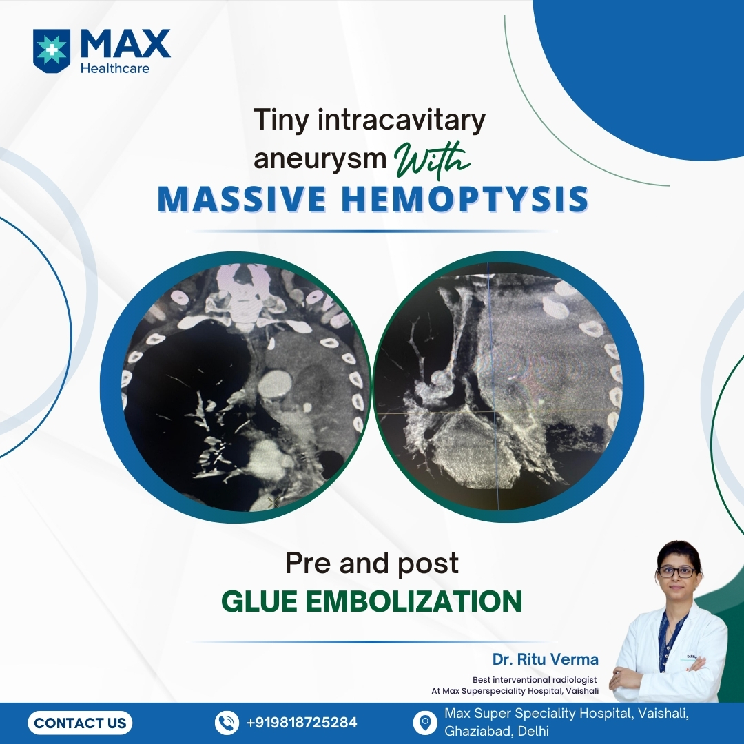 dr_rituverma's tweet photo. @dr_rituverma  Massive Hemoptysis due to Tiny Intracavitary Aneurysm?
#InterventionalRadiology #GlueEmbolization #HemoptysisTreatment #AneurysmCare #MinimallyInvasive #DrRituVerma #BestRadiologistNoida #topdoctor #PatientFirst https://t.co/ArkUn4jJAo