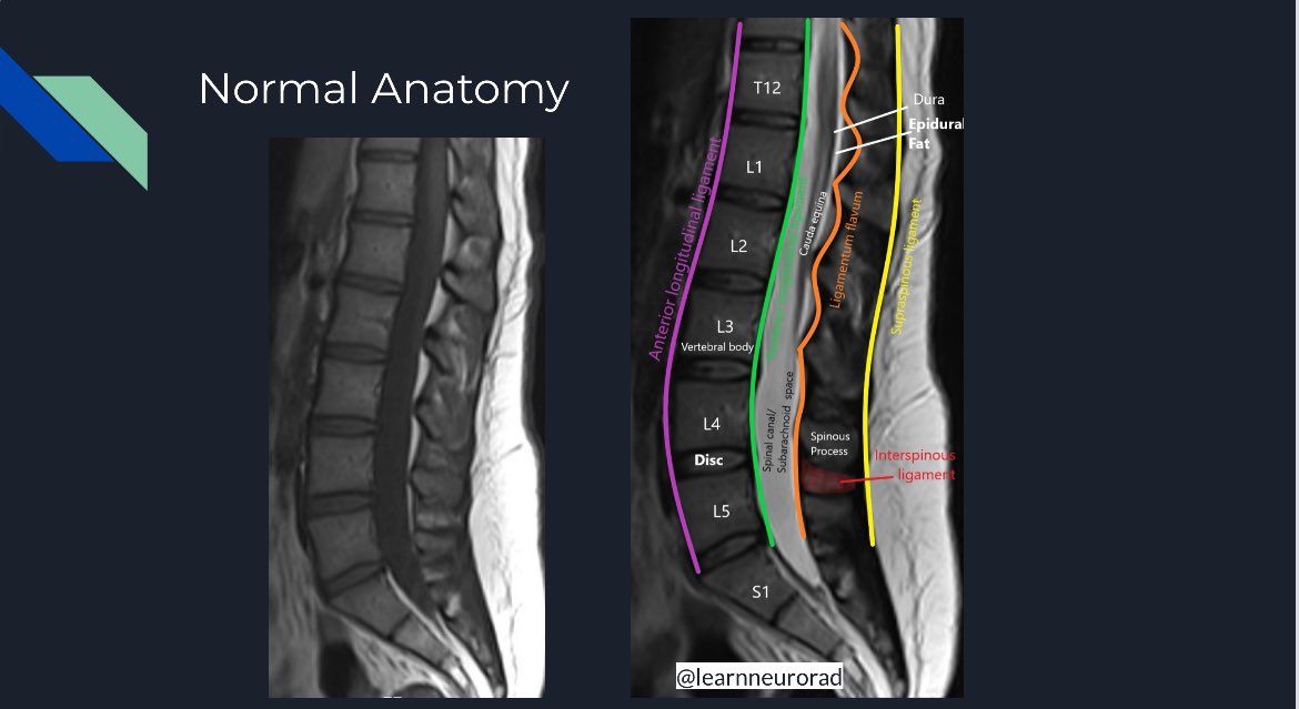 Normal anatomy of the lumbar spine #radres #Neurorad