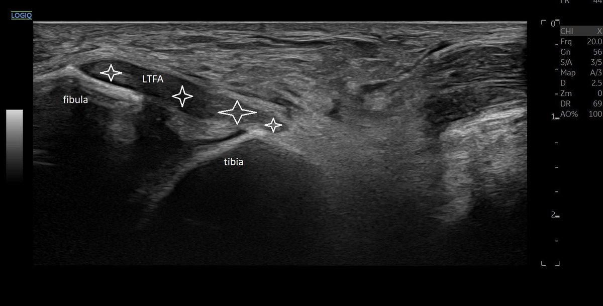 SportklinikBern's tweet photo. Partial #ltfa rupture after ankle sprain in 1️⃣ #functionalultrasoundimaging 2️⃣ injured side 3️⃣ healthy side  - #mskus #pocus #pocushub #GElogiqE10sr4 https://t.co/1bYfrqFOhQ
