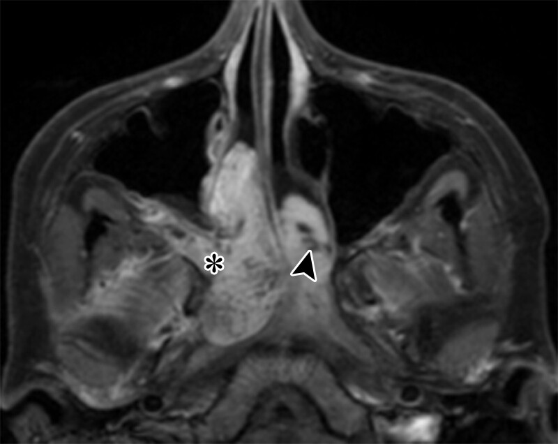 Aashim Bhatia, M.D., M.S. (@draash) on Twitter photo Fantastic review from the superstars! @VUMCradiology <a href="/CHOPRadiology/">CHOP Radiology</a> Nontraumatic Pediatric Head and Neck Emergencies: Resource for On-Call Radiologists | RadioGraphics pubs.rsna.org/doi/10.1148/rg… Fantastic review from the superstars! @VUMCradiology <a href="/CHOPRadiology/">CHOP Radiology</a> Nontraumatic Pediatric Head and Neck Emergencies: Resource for On-Call Radiologists | RadioGraphics pubs.rsna.org/doi/10.1148/rg…