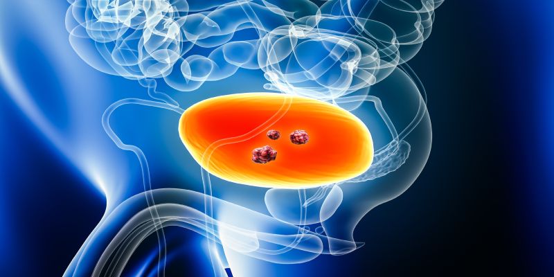 GUOncologyNow's tweet photo. Incoming ✈️ #ESMO24 data from @tompowles1 on #PFS and #OS benefit with #EVplusPembro in #metastatic #locallyadvanced #urothelialcarcinoma across all #subgroups.
🧠 Learn more: https://t.co/IWDxj09gip https://t.co/tcmukjSRhn