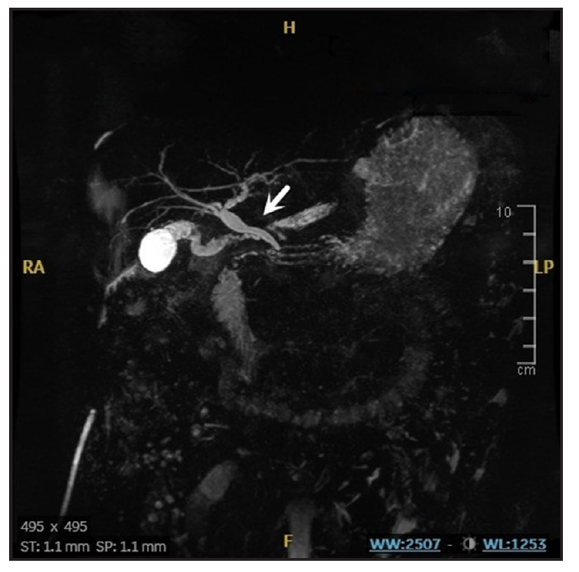 🧔 43 años

🏥Ingresa en nuestro servicio por 
a un accidente
📈Ante la presencia de dolor abdominal

⚡ Se realiza TC y se completa con colangio-RM

🔦 IMAGEN

#MartesREED