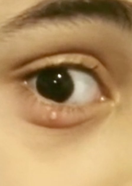TahaSunbul's tweet photo. بعض الاطفال بشرتهم دهنية وتسبب لهم اكياس دهنية بالجفن ( ضبضوب ) 
اعراضها
انتفاخ
احمرار 
الم 
وعلاجها
بالكمادات الحارة 
اذا لم تختفي خلال ايام راجع طبيب عيون 

@_saudicommunity @hashksa @consumer_eye https://t.co/cZksgTWEQY