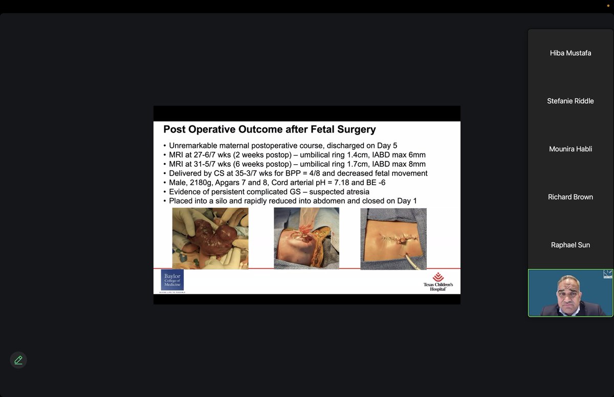 NAFTNet (@naftnet) on Twitter photo We were honored to have <a href="/sgkeswani/">Sundeep Keswani</a> join our first NAFTNet webinar. He shared with us the outcomes of the first human patient of the feasibility trial for fetal surgical repair of #gastroschisis
The trial started after 7 years of research work with animal studies.
<a href="/APSASurgeons/">APSA Surgeons</a> We were honored to have <a href="/sgkeswani/">Sundeep Keswani</a> join our first NAFTNet webinar. He shared with us the outcomes of the first human patient of the feasibility trial for fetal surgical repair of #gastroschisis
The trial started after 7 years of research work with animal studies.
<a href="/APSASurgeons/">APSA Surgeons</a>