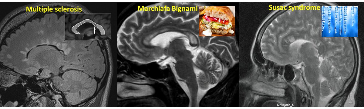 🧠Non neoplastic corpus callosal lesions:
Multiple sclerosis - Involves callososeptal interface
Marchiafa Bignami - Involves central layers with relative sparing of the dorsal&amp;ventral extremes(Sandwich)
Susac syndrome -Spherical/round lesions in the center of CC(Snowball/Icicles)