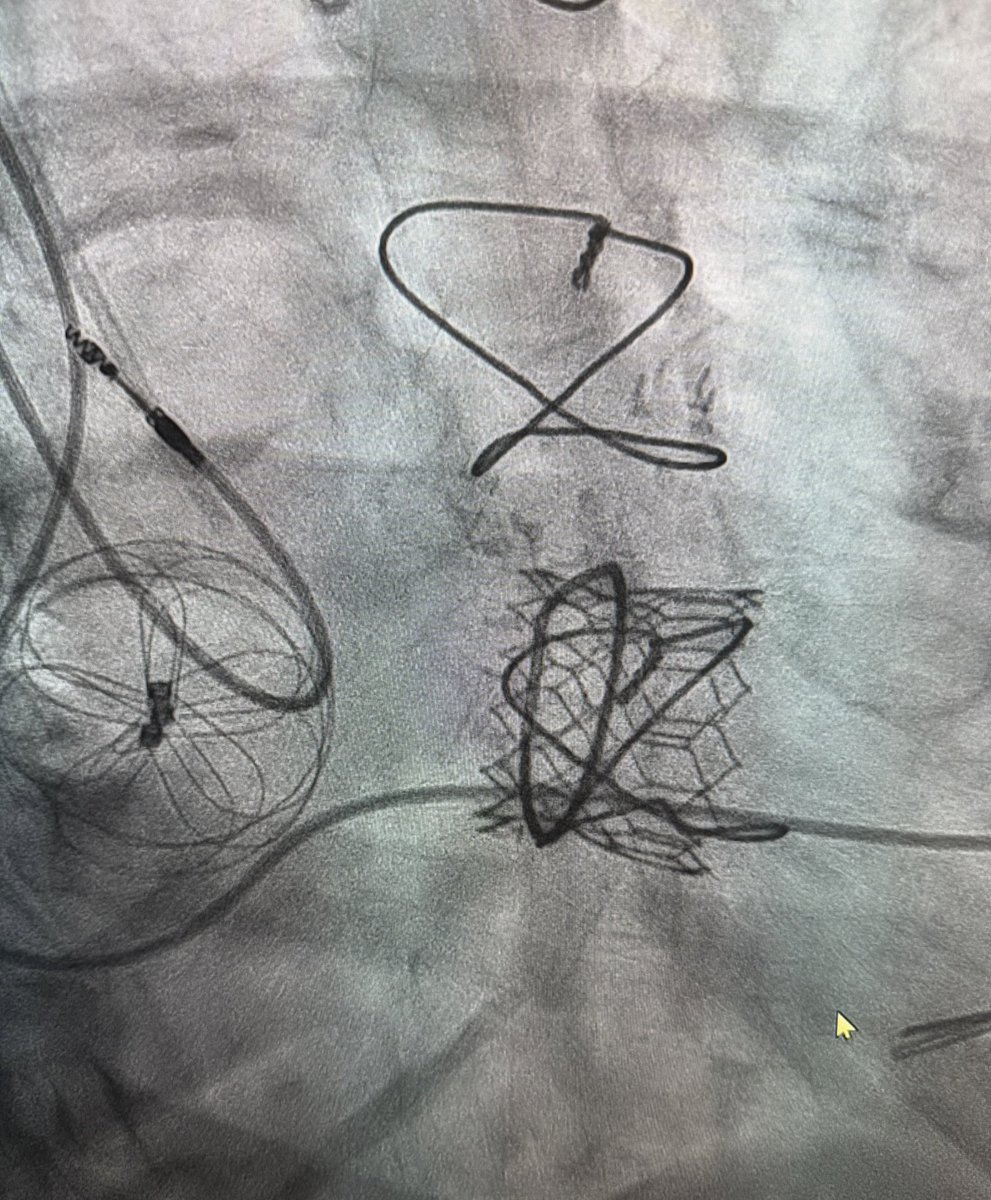 Laceration of the Anterior Mitral Leaflet #LAMPOON and #TMVR Valve-in-Ring for mitral stenosis in patient with 2 previous heart surgeries. Electrosurgery and complex structural heart intervention things you only find at few leading valve programs in the country.