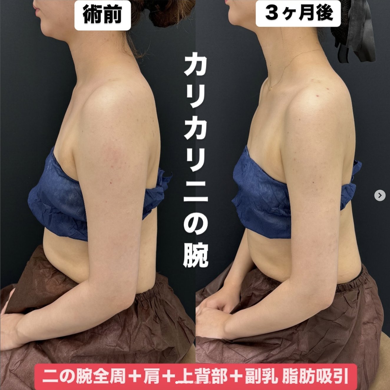 副乳 
