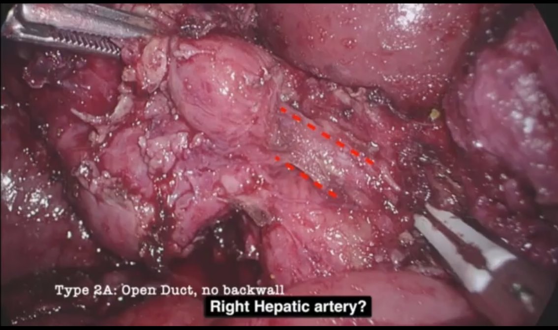 HPB unit Hospital del Mar (@hpbmar) on Twitter photo ⚠️WHICH TYPE OF SUBTOTAL CHOLECYSTECTOMY❓HOW TO DO CORRECTLY❓
This technique must be learned and executed correctly 🔔
In <a href="/UpdatesSurgery/">Updates in Surgery</a> we describe all types with tricks and tips
Find out more in the video 📹at the end of 👉 link.springer.com/article/10.100… ⚠️WHICH TYPE OF SUBTOTAL CHOLECYSTECTOMY❓HOW TO DO CORRECTLY❓
This technique must be learned and executed correctly 🔔
In <a href="/UpdatesSurgery/">Updates in Surgery</a> we describe all types with tricks and tips
Find out more in the video 📹at the end of 👉 link.springer.com/article/10.100…