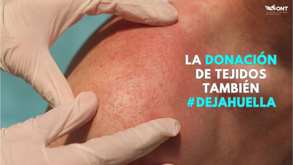ONT_esp's tweet photo. ⁉️ ¿Sabías que un #trasplante de piel puede salvar la vida de una persona que haya sufrido quemaduras severas? Una única #donación de tejidos puede beneficiar a más de 100 personas. ¡Haz que tus tejidos también dejen huella! #OrgulloONT💙 https://t.co/lTERh1CqlE
