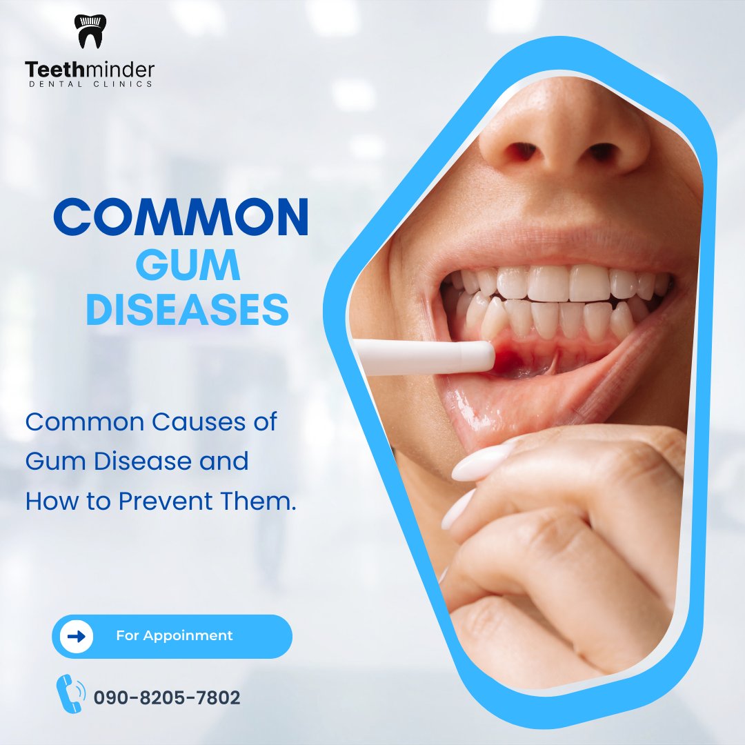 teethminder's tweet photo. Gum disease can lead to tooth loss. Learn its common causes and prevention tips like brushing, flossing, and regular dental check-ups.

#GumHealth #DentalCare #HealthyGums #PreventGumDisease #Teethminder https://t.co/yImnOCPCMY