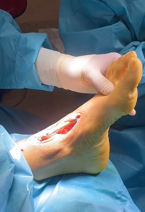 ClinicaCEMTRO (@clinicacemtro) on Twitter photo 🥼Rotura subaguda del tendón tibial anterior:
🔹Paciente sin antecedente traumático nota caída de pie y bultoma anterior de tobillo
🔹Debido a la imposibilidad de la reparación directa, se realiza reconstrucción con injerto y reinserción con técnica tibial Button
<a href="/DrSergiohorte/">Dr. Sergio Hortelano</a> 🥼Rotura subaguda del tendón tibial anterior:
🔹Paciente sin antecedente traumático nota caída de pie y bultoma anterior de tobillo
🔹Debido a la imposibilidad de la reparación directa, se realiza reconstrucción con injerto y reinserción con técnica tibial Button
<a href="/DrSergiohorte/">Dr. Sergio Hortelano</a>