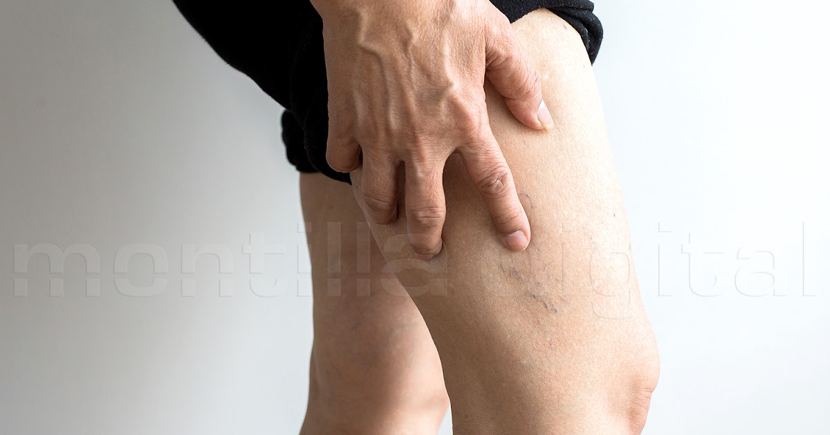 Las enfermedades venosas aumentan más de un 30% tras el verano dlvr.it/TDBk0K