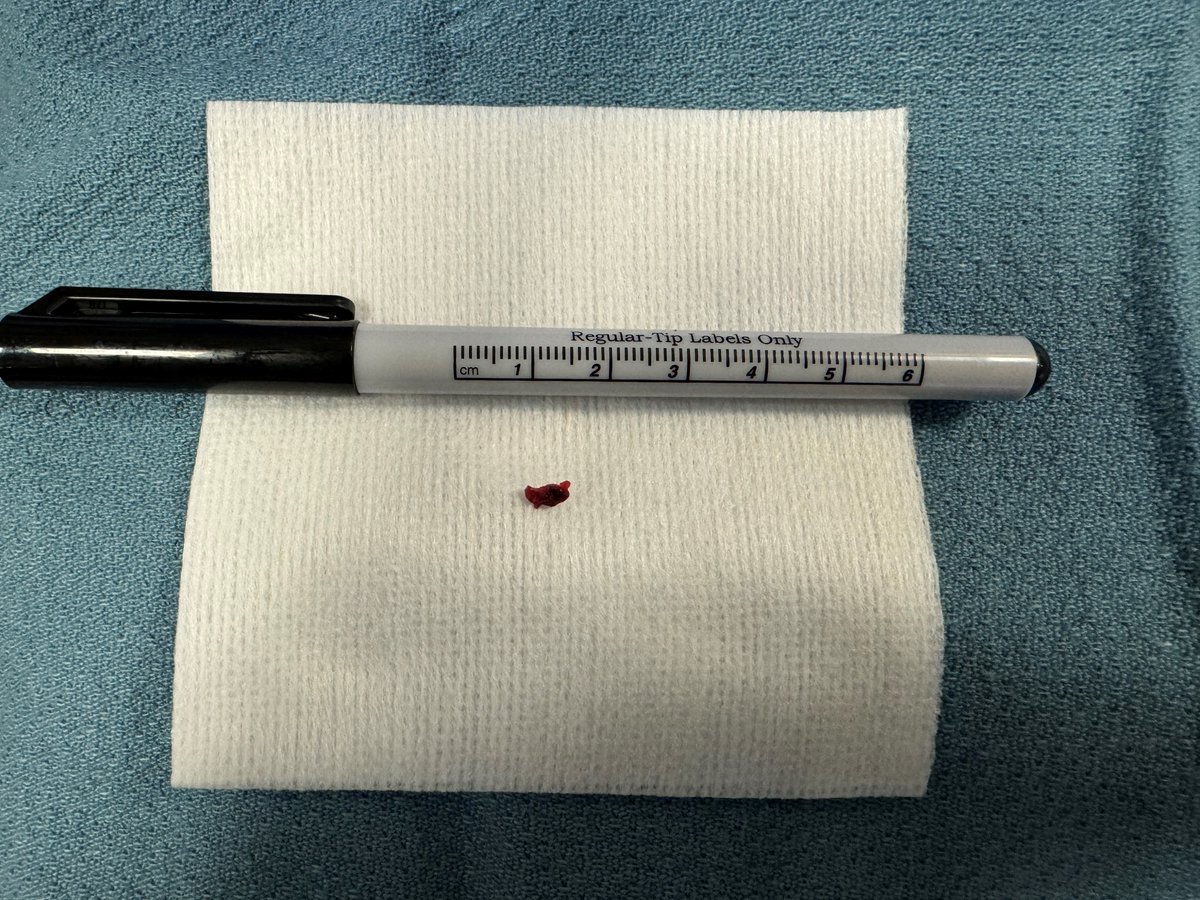Sabeen Dhand (@sdhandmd) on Twitter photo 87 yo w/ right sided weakness and left sided gaze preference
LMCA syndrome mimicker: left p2PCA embolus
s/p transradial ADAPT with 7Fr slender, BMX81, Red62/43 combo --> speech and motor back to normal!!!
#stroke #MeVO #posterior #bao <a href="/_backtable/">BackTable Vascular and Interventional</a>
<a href="/PascalJabbourMD/">Pascal Jabbour MD, FAANS, FACS, FAHA</a> 87 yo w/ right sided weakness and left sided gaze preference
LMCA syndrome mimicker: left p2PCA embolus
s/p transradial ADAPT with 7Fr slender, BMX81, Red62/43 combo --> speech and motor back to normal!!!
#stroke #MeVO #posterior #bao <a href="/_backtable/">BackTable Vascular and Interventional</a>
<a href="/PascalJabbourMD/">Pascal Jabbour MD, FAANS, FACS, FAHA</a>