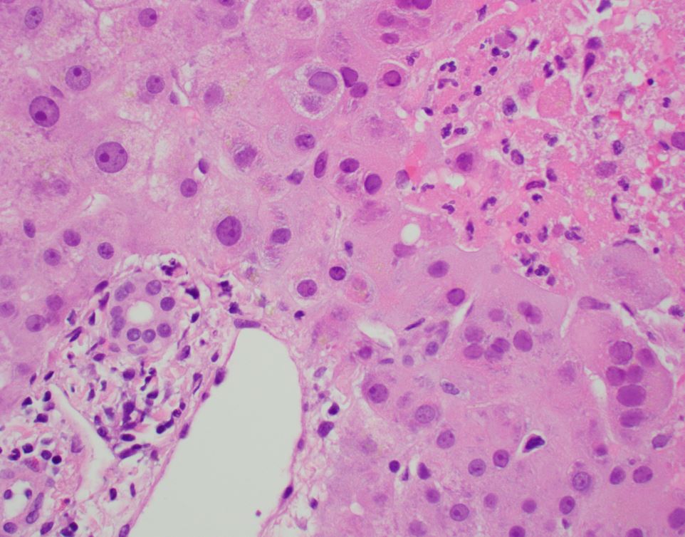 GIPathologyURMC's tweet photo. HSV hepatitis. Sharply defined foci of coagulative necrosis with infected multinucleated cells and positive HSV IHC. #LiverPath #HepPath #GIPath #Histopathology #Pathology #PathBoards #PathResidents #PathTweetorial #pathx #pathtwitter #GIPath #PathTweetAward #SurgPath https://t.co/i1ePvplS7H