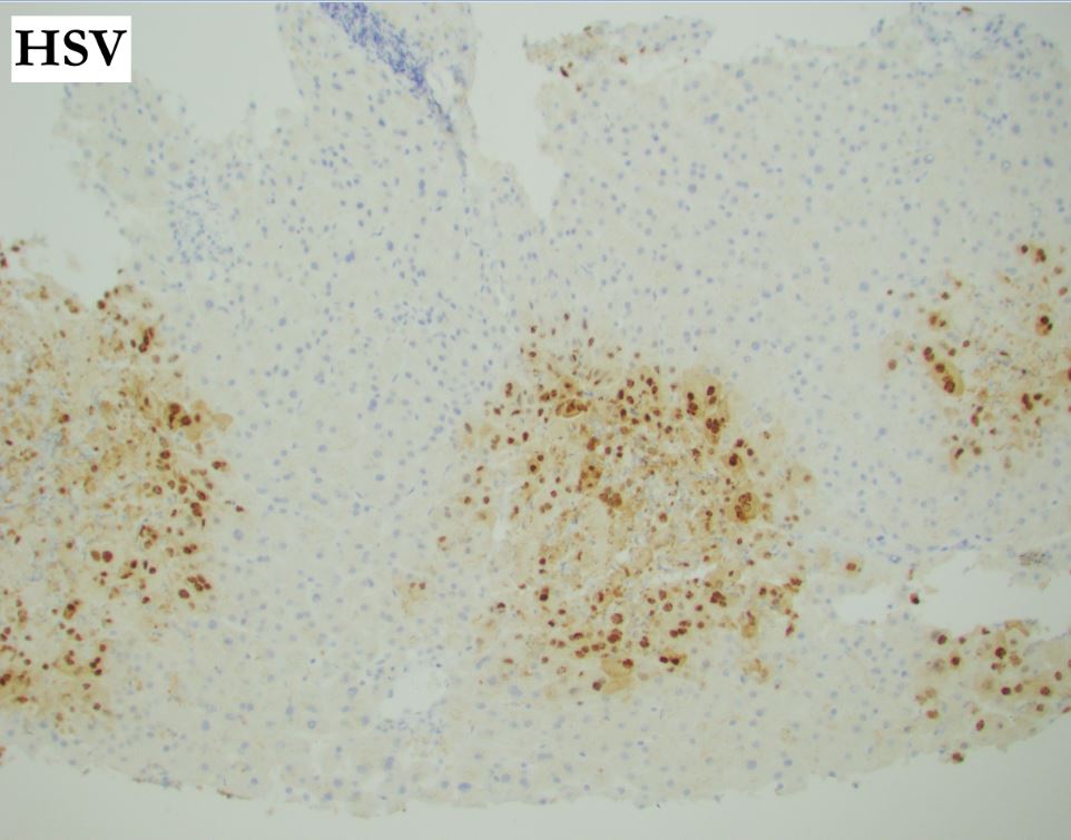 HSV hepatitis. Sharply defined foci of coagulative necrosis with infected multinucleated cells and positive HSV IHC. #LiverPath #HepPath #GIPath #Histopathology #Pathology #PathBoards #PathResidents #PathTweetorial #pathx #pathtwitter #GIPath #PathTweetAward #SurgPath