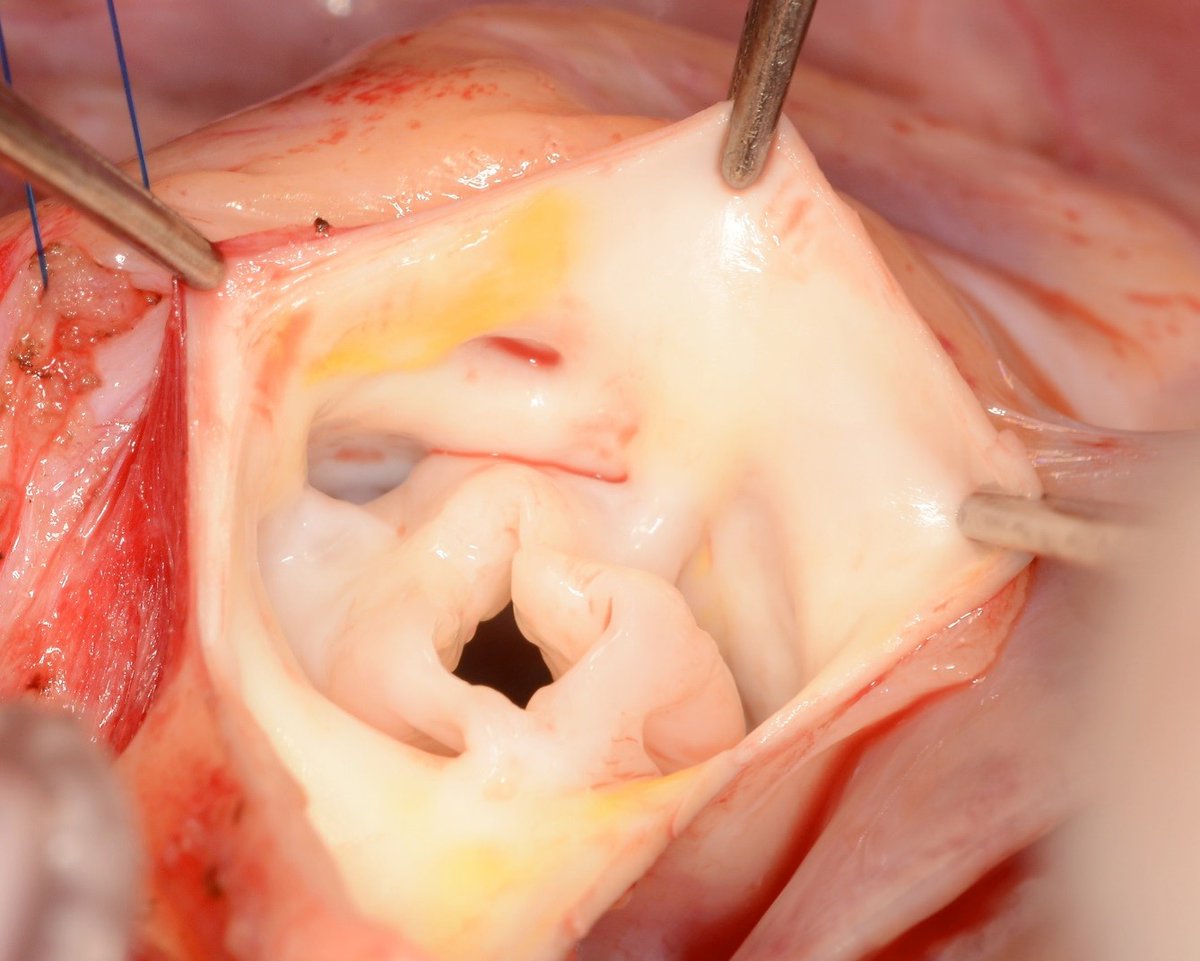 Operative mortality of Ross operation in neonates is 13%, post discharge mortality is 8%. Aortic valve repair or Ross in neonates? For detail read: Long-term outcomes following the Ross procedure in neonates and infants: A multi-institutional analysis pubmed.ncbi.nlm.nih.gov/38971401/
