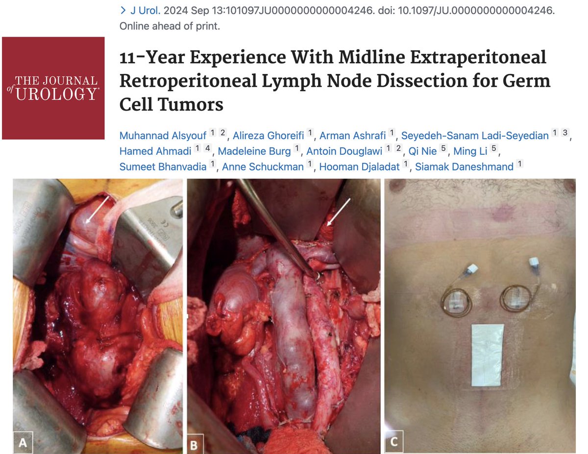 Alireza Ghoreifi, MD (@alirezaghoreifi) on Twitter photo 🔥Hot off the press in <a href="/JUrology/">Journal of Urology</a>. Kudos to <a href="/UroAlsyouf/">Muhannad Alsyouf</a> and <a href="/siadaneshmand/">Sia Daneshmand, M.D.</a>!
1⃣237 EP-RPLNDs
2⃣Median LOS: 2d
3⃣30d complications: 13%; no postop ileus or SBO
4⃣Great onc outcomes in primary and post-chemo settings; 7 in-field recurrences
🔗Free access link: auajournals.org/doi/10.1097/JU… 🔥Hot off the press in <a href="/JUrology/">Journal of Urology</a>. Kudos to <a href="/UroAlsyouf/">Muhannad Alsyouf</a> and <a href="/siadaneshmand/">Sia Daneshmand, M.D.</a>!
1⃣237 EP-RPLNDs
2⃣Median LOS: 2d
3⃣30d complications: 13%; no postop ileus or SBO
4⃣Great onc outcomes in primary and post-chemo settings; 7 in-field recurrences
🔗Free access link: auajournals.org/doi/10.1097/JU…