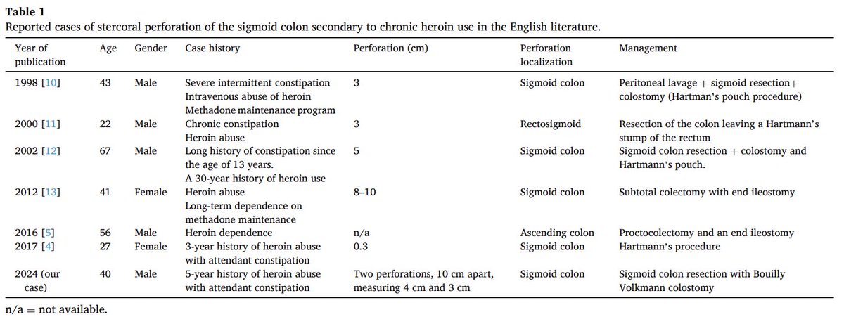 Another #stoolcankill  case of stercoral perforation in a 40-year-old with chronic heroin use. Highlights the dangers of opioid-induced constipation and the importance of early intervention and addiction care. #GiTwitter pubmed.ncbi.nlm.nih.gov/39299203/