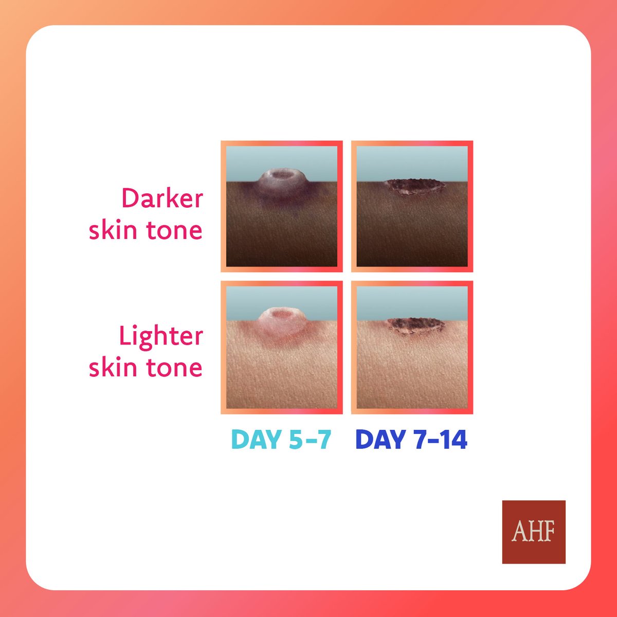 The #Mpox outbreak continues to affect several African countries. Protect yourself &amp; your community by staying informed, practicing safe interactions (including using condoms w/ sexual partners), and seeking care if needed. Learn more:  shorturl.at/p9DY8