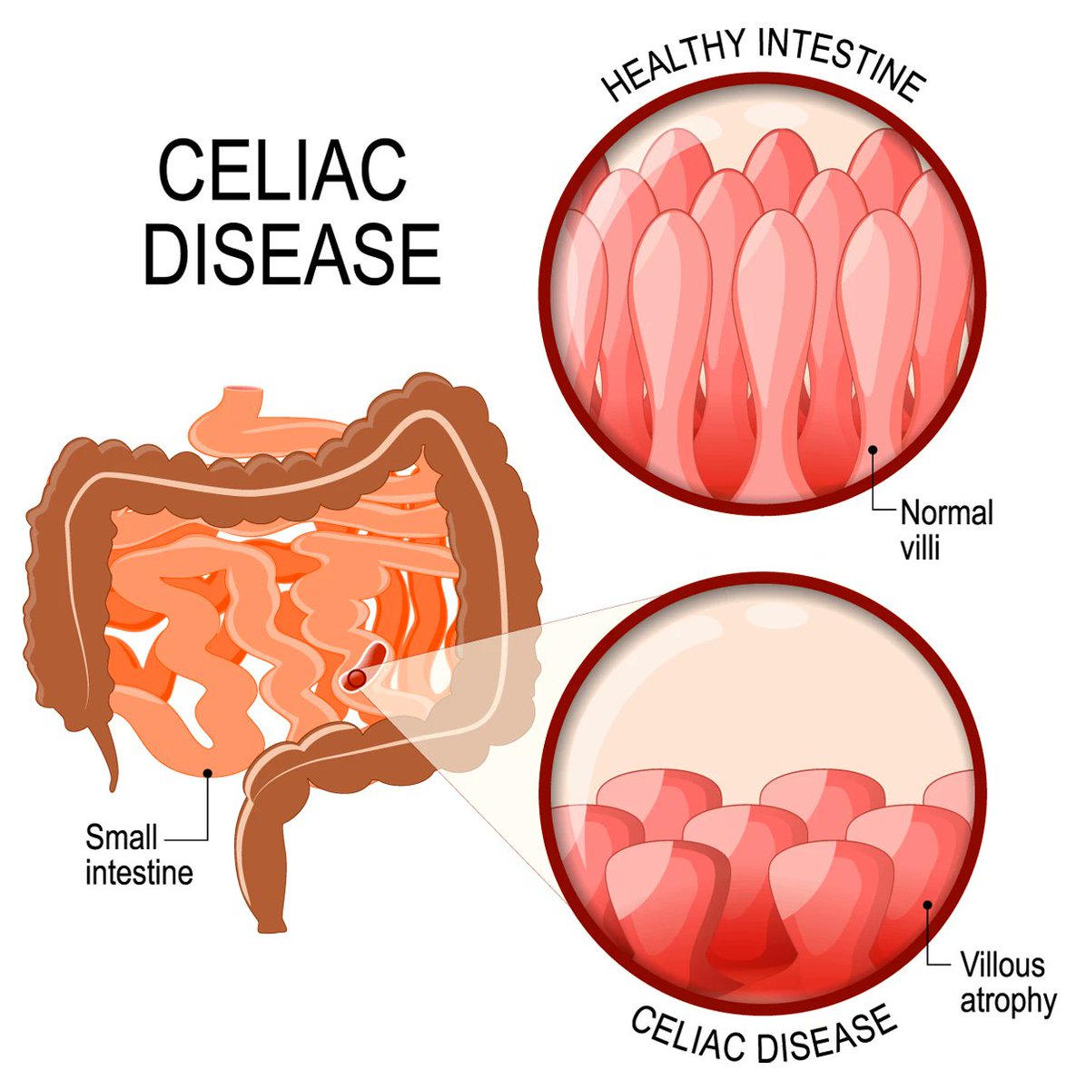 emergencyres's tweet photo. Celiac disease is an autoimmune disorder that’s triggered when eat gluten a protein found in wheat, barley, and other grains. The condition is also known as celiac sprue, nontropical sprue, gluten-sensitive enteropathy.
Visit us: https://t.co/ar7XoKr0te
#celiac #disease #protein https://t.co/NajT6dAd0W
