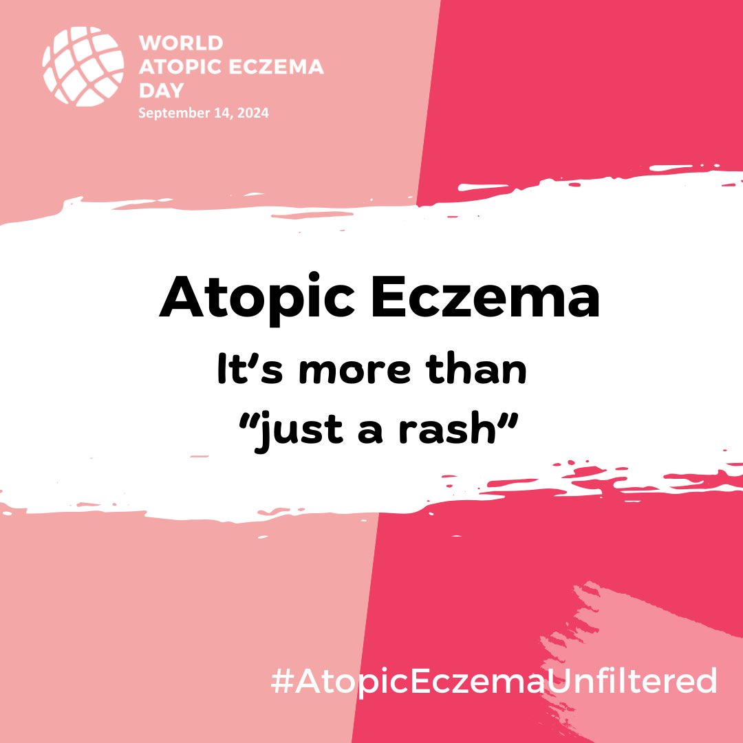 Eczema can be red, itchy, dry, scaly &amp; sore. 

It can also be embarrassing, isolating &amp; expensive among other things. It’s not “just a rash”.

How has #atopiceczema affected you?

#WorldAtopicEczemaDay #worldatopicdermatitisday #atopiceczemaunfiltered #eczemamum #eczemamom