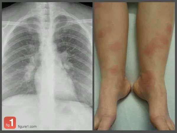 IhabFathiSulima's tweet photo. What is the cause of acute arthritis in this patient ? https://t.co/XjqPD48nvM