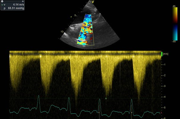 Eco-Duda frecuente  <a href="/EchofirstB/">Echofirst Bot</a>  
Velocidad aumentada en #Aorta descendente... 
¿Cuándo es normal y cuándo coartación?
En la coartación no solo tenemos
⬆️Velocidad (>2m/s) = aliasing
👉Rampa diastólica (flujo presente en diástole)
⏫Radio vel diastólica/vel sist  (>0,5 🥴)