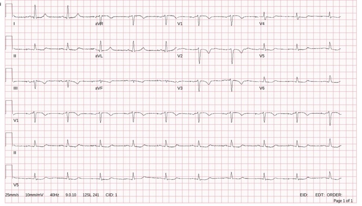 We successfully performed the first Abbott LBB area pacing (using CPC Direct Universal 3D and Tendril STS) implantations in Türkiye
#EPeeps #CardioTwitter