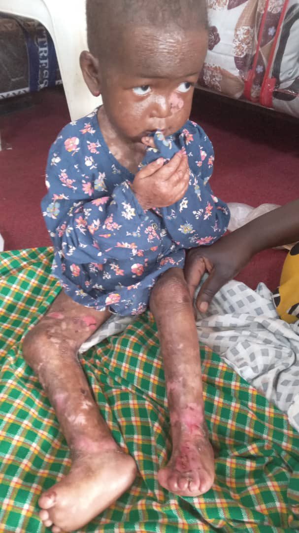 Hear me out🥹🙏🏾!
This post comes with graphic images🥹🙏🏾. Nankwangi Lousa is a 3year old girl whose life has been affected by a condition called Epidermyollasis bullosa. She lives in pain, her childhood is different from that of her mates 1/1