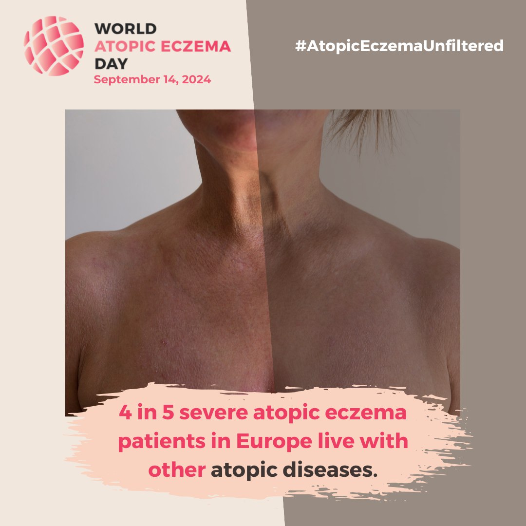 EFA_Patients's tweet photo. Too many #atopiceczema patients face barriers to timely, effective treatment, causing pain and worsening symptoms.
We must ensure access to proper #dermatologic care across Europe.
📢 Advocate for change with #AtopicEczemaUnfiltered! #AtopicEczemaDay 🖇 https://t.co/AnN0gKFl1t https://t.co/V7Ifwau54k