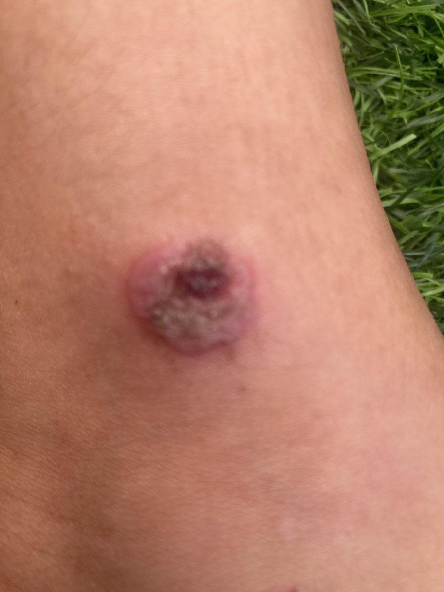 mariamradi13's tweet photo. Yamen: He has this bacterial infection in his body. I tried in every way to prevent this, but stopping the medication made the situation worse. Diseases spread everywhere. Please help my children survive ☹️😣

https://t.co/d181L0CM4J
https://t.co/j0uAdwvW9f https://t.co/jmhJjkJ3vl