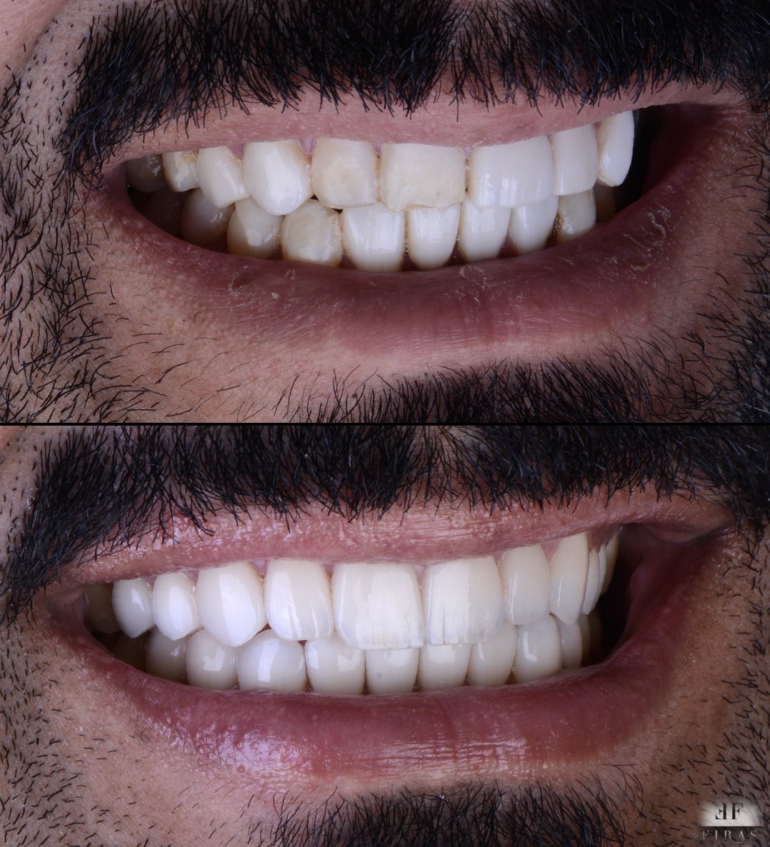 A smile that sets you for life 

ابتسامة جميلة تصنع حياة اجمل

<a href="/dentalhousec/">Dental House Clinics</a> 

#khobar #dammam #dhahran #ksa #saudiarabia #smile #veneers #crown #crowns #hollywood #hollywoodsmile #dentist #dentistry #photography #beauty #natural_smile #manama #bahrain #dentalhouseclinics