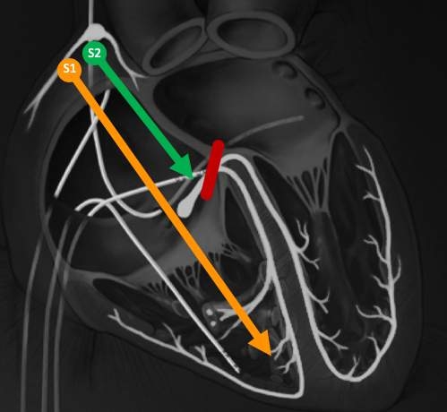 ChartAcademy's tweet image. Cardiac EGMs...we are keeping that vibe through the weekend for all our #CHARTpeeps! 🫣

Blog: bit.ly/3B3XtjE ⬅️✅

#EPeeps #VivaEP
#pacingmaneuvers #tachycardia #electrophysiology #cardiology #healthcare #stafftraining #ablation #Afib #nurse #CVT #BME #RadTech