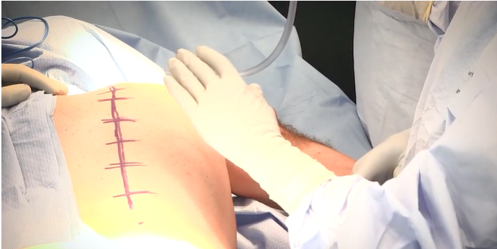 AAOS1's tweet image. Today on #OVT watch the demonstration of a trapezius muscle transfer in a patient with a history of #brachial #plexus palsy: bit.ly/3HCc7PT
 
@JanetConway
#LifeBridgeHealth
@ASESmembers
#orthotwitter
@AOSSM_SportsMed
@otatrauma

View 1600+ surgical technique videos!