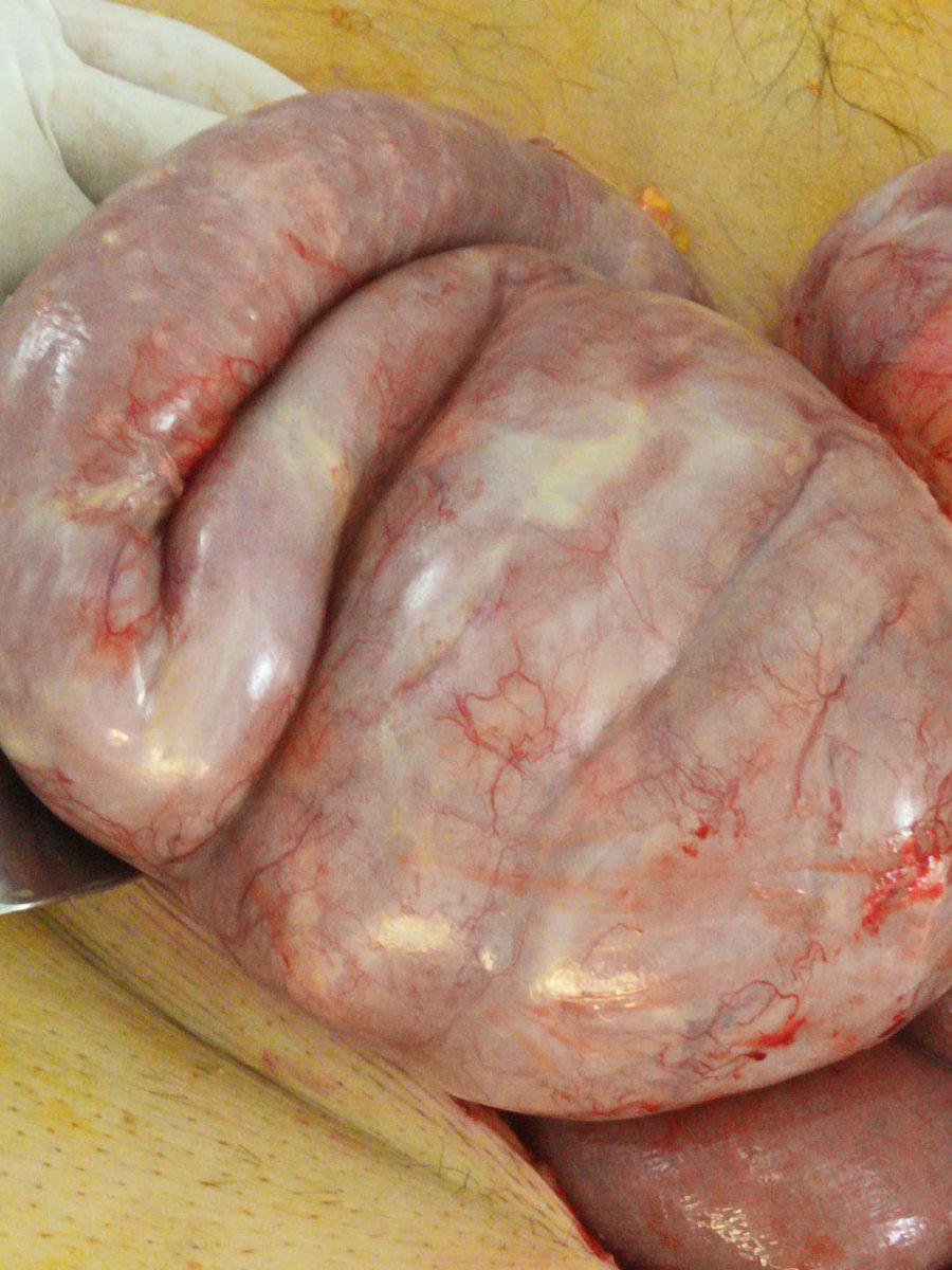 MartinVargas89's tweet photo. Male 78y, septick shock and bowel obstruction, after 5 years of #PD and multiple associated peritonitis.  

Better to save lives, not catheters. https://t.co/Bie3RTrfmU