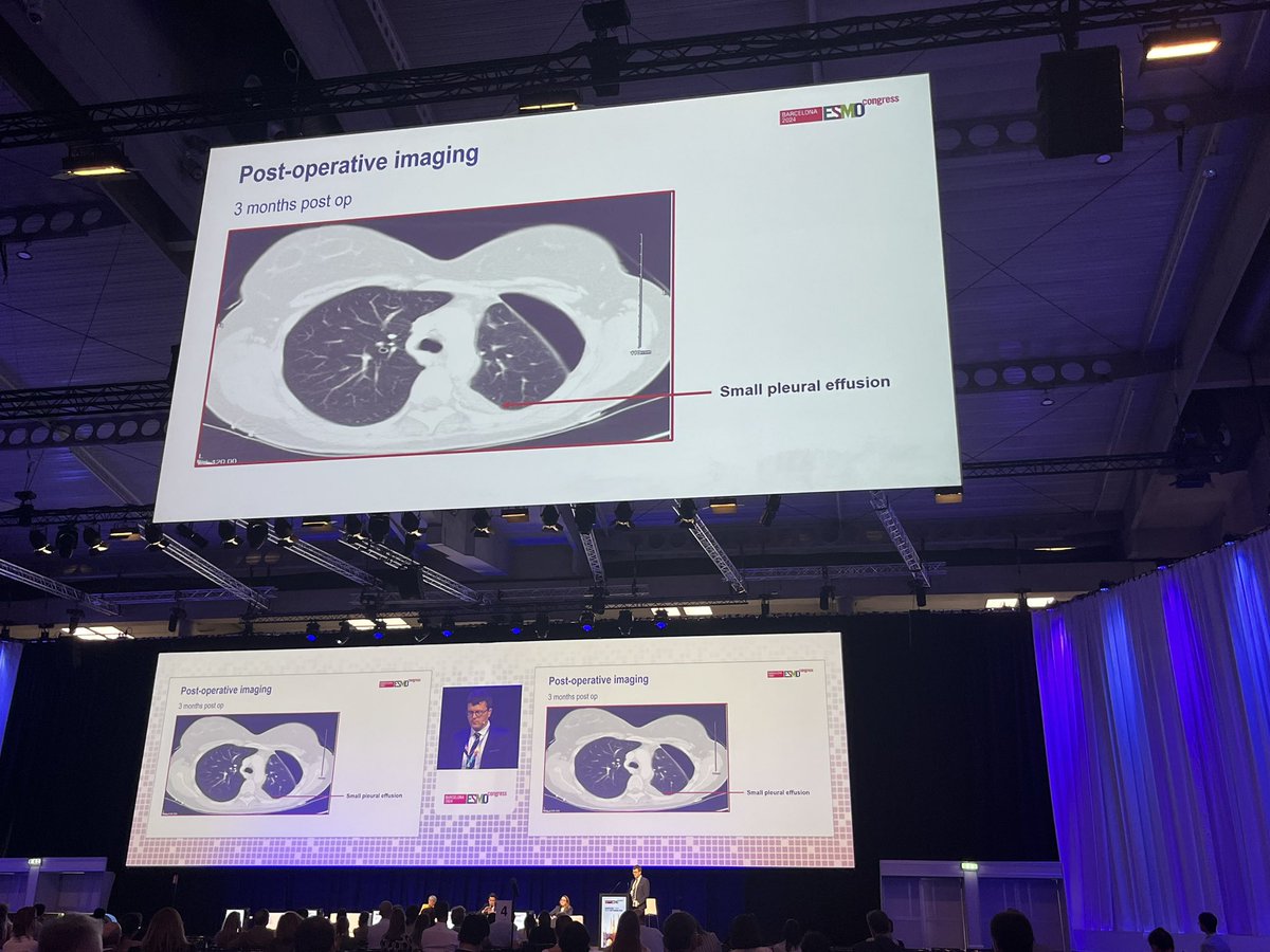 Caroline O'Leary (@colearyirl) on Twitter photo Congratulations to <a href="/DavidOReilly2/">David O Reilly</a> on his excellent presentation of a very interesting mesothelioma case at #ESMO24 ๐๐ป Congratulations to <a href="/DavidOReilly2/">David O Reilly</a> on his excellent presentation of a very interesting mesothelioma case at #ESMO24 ๐๐ป