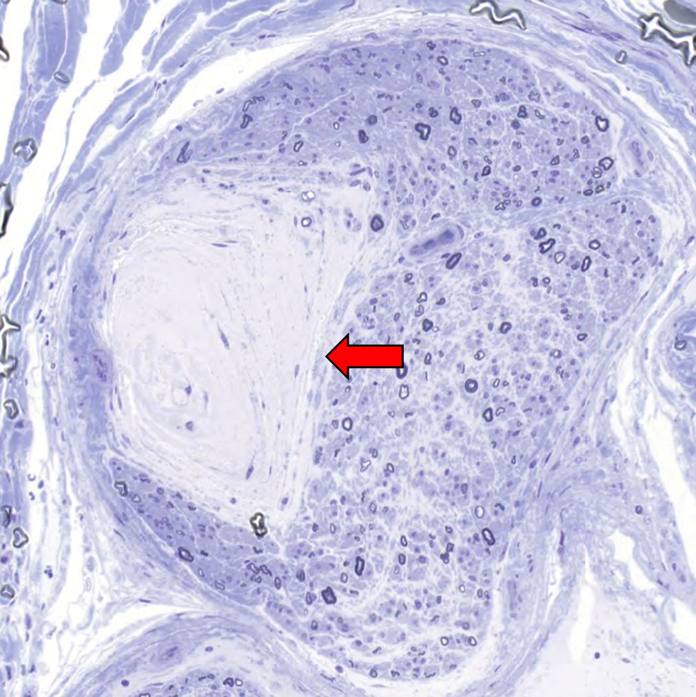Toluidine-stained cross section of a sural nerve. What is the structure indicated by the red arrow? (I'll go out for a nice country drive in my RENAULT sports car while you're thinking about it.) #pathology #neuropath #PathTwitter