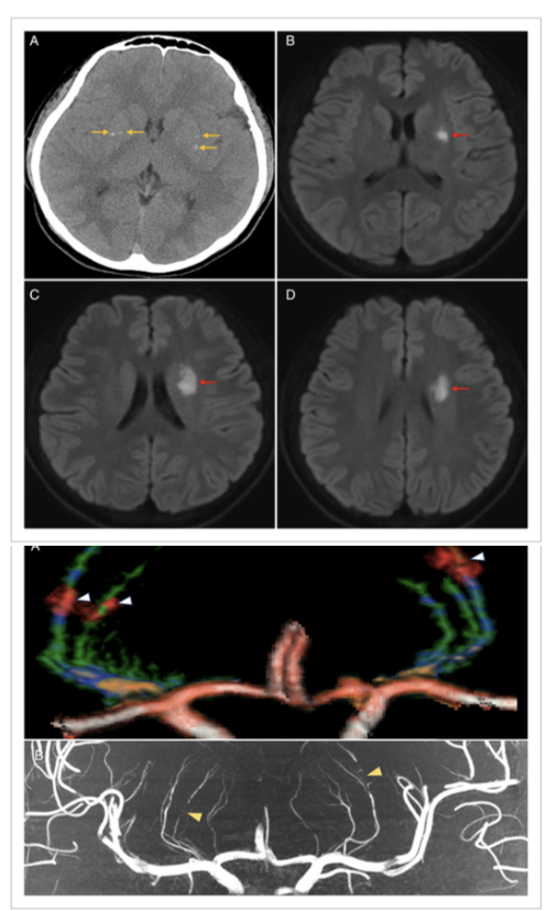 Michael Okun (@michaelokun) on Twitter photo Have you seen this syndrome? Mineralizing lenticulostriate vasculopathy and traumatic infarction? Basal ganglia involvement and NO movement disorder. Great case in Annals of Neurology <a href="/TheNewANA1/">American Neurological Association</a> by Li and colleagues.
Key Points:
- A 14 you had loss of consciousness.
- Then a Have you seen this syndrome? Mineralizing lenticulostriate vasculopathy and traumatic infarction? Basal ganglia involvement and NO movement disorder. Great case in Annals of Neurology <a href="/TheNewANA1/">American Neurological Association</a> by Li and colleagues.
Key Points:
- A 14 you had loss of consciousness.
- Then a