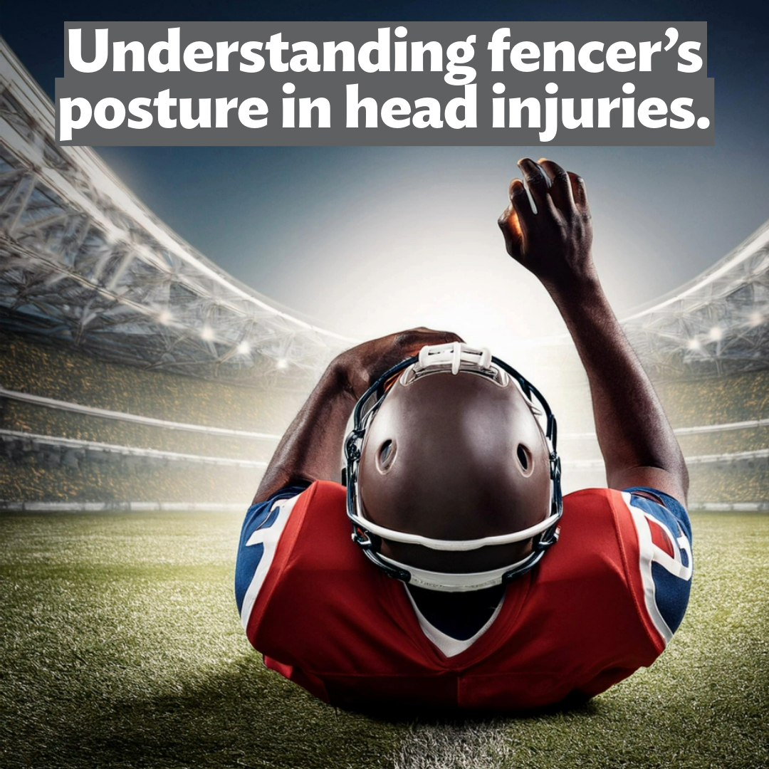 Earlier this week, Tua Tagovailoa suffered a concussion, displaying what’s known as fencer’s posture.

Fencer’s posture occurs when the brain’s motor control is disrupted after a significant head injury. The athlete may extend their arms rigidly, resembling a fencer’s stance.