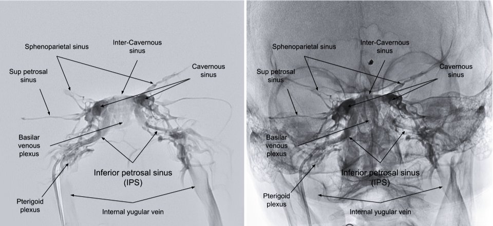 CarlosSantosJi3's tweet photo. Inferior petrosal sinus venography. Neuroaurgeons must familiarize with this images for the near future. The eshunt is coming to stay among us. https://t.co/B9aObItpSI