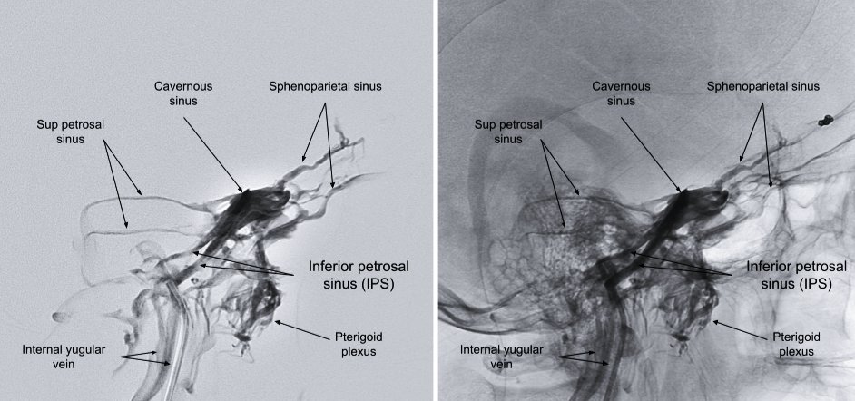 Inferior petrosal sinus venography. Neuroaurgeons must familiarize with this images for the near future. The eshunt is coming to stay among us.