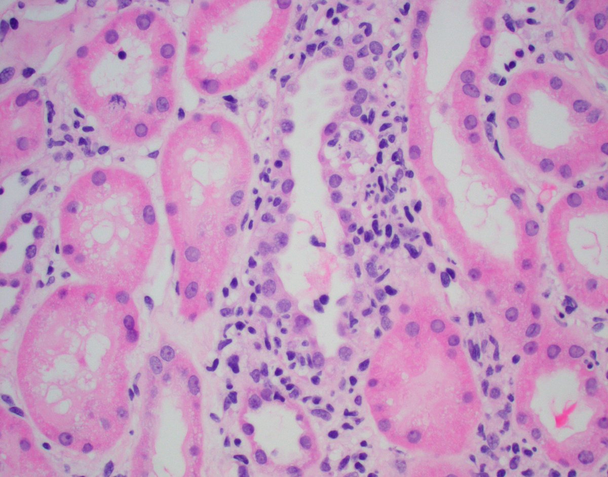Transplant kidney biopsy with stable normal sCr but elevated serum donor cell free DNA - an increasingly common indication for bx. Severe subclinical cellular rejection. Severe tubulitis (t3).  #renalpath #pathtwitter #nephrology