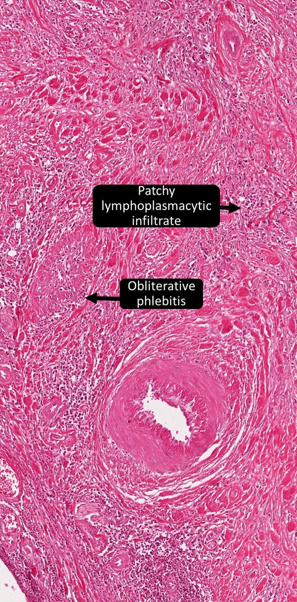 DrCycloPath's tweet photo. ✅Riedel Thyroiditis
potentially an IgG4-related disease (storiform fibrosis, obliterative phlebitis)
patchy infiltrate, extension beyond capsule
replacement of lobular architecture
🔬https://t.co/9OaWRL1PLl
🔬https://t.co/uAy0iAC5aV
#Thyroid #EndoPath #ENTPath #PathTwitter #Pathology #Pathologists